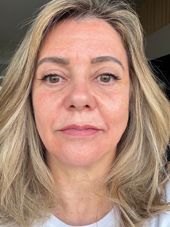 Mesmo rosto de frente depois do tratamento